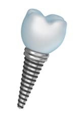 woman holding dental implant