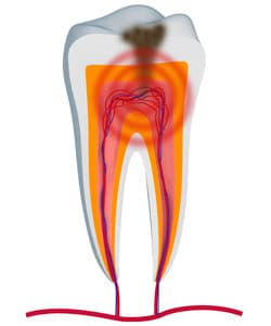 Root canal treatment in Claremore, OK