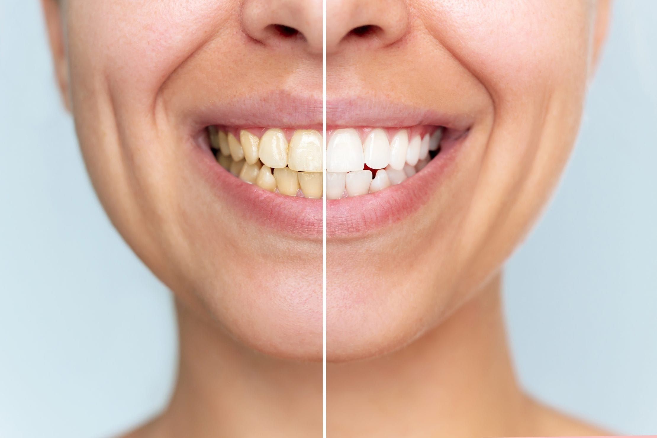 How Professional Teeth Whitening Works