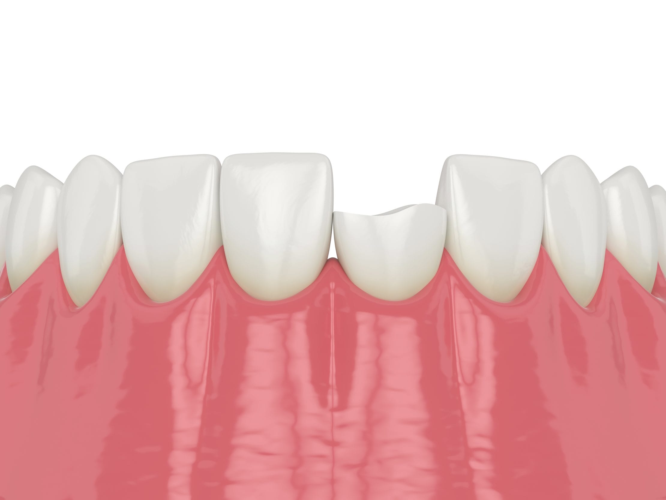 Do I Really Need to Fix a Small Chip If It Doesn’t Hurt?