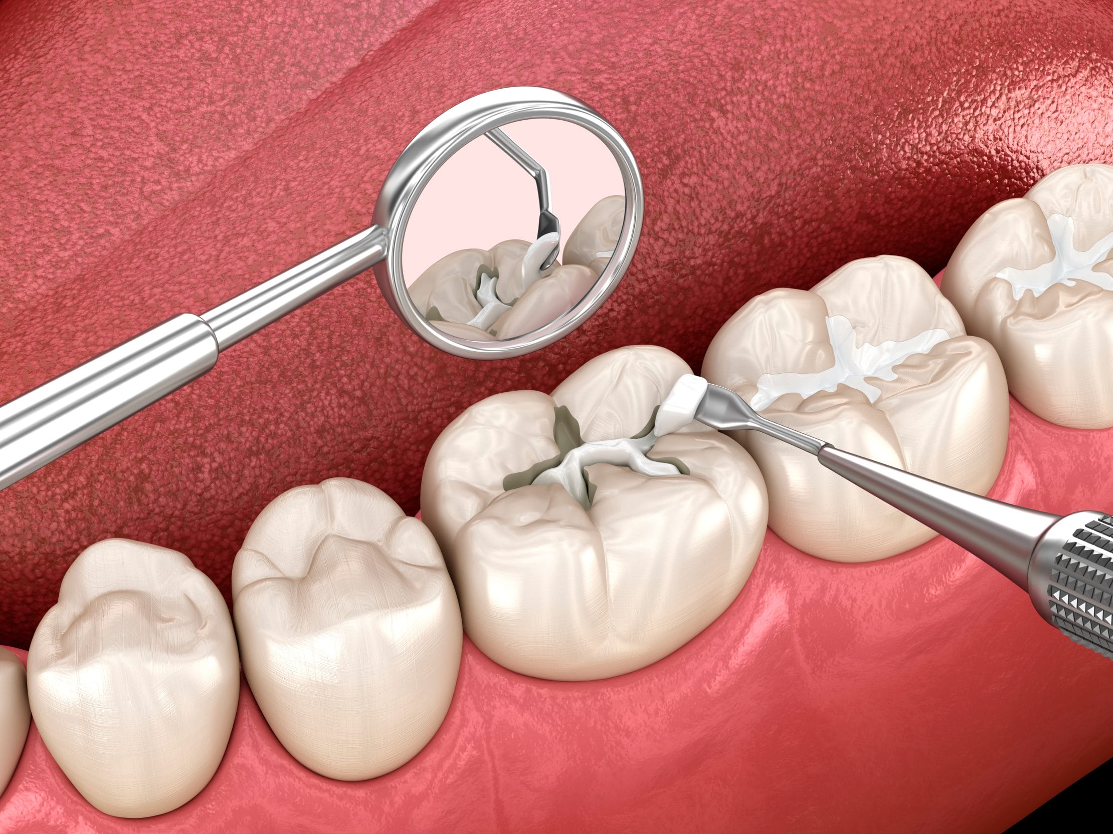Why Your Dentist Recommends Replacing a Filling That Feels Fine